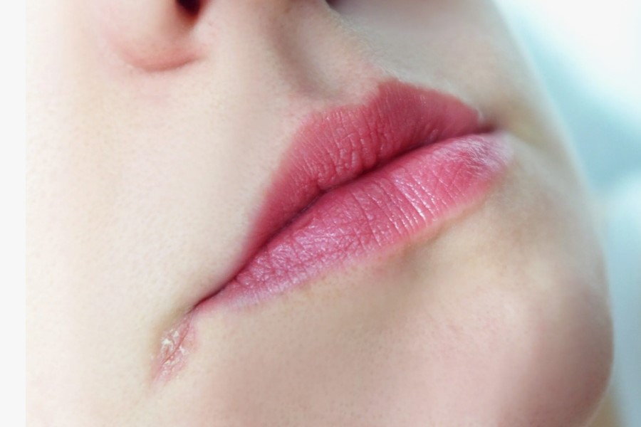 Заеды: почему трескаются уголки губ и как вернуть коже спокойствие